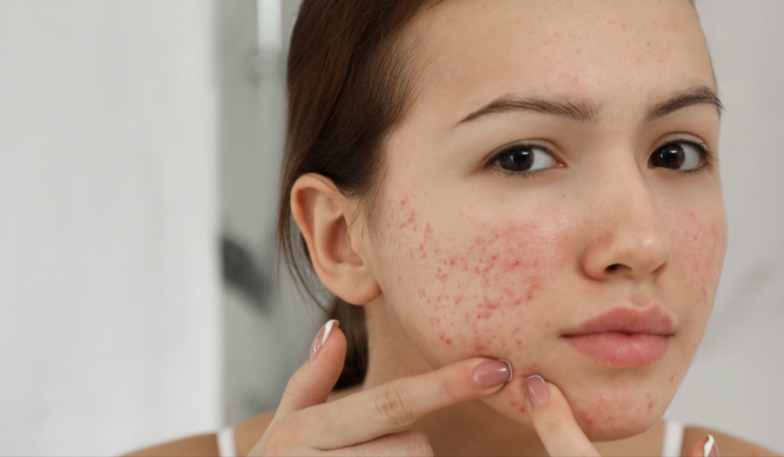 Clinical Approaches for Treating Active Acne